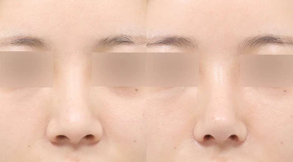 Rhinoplasty [Revisi / Hidung panjang] / Reduksi cuping / Rhinoplasty fungsional / Tulang rawan iga sendiri