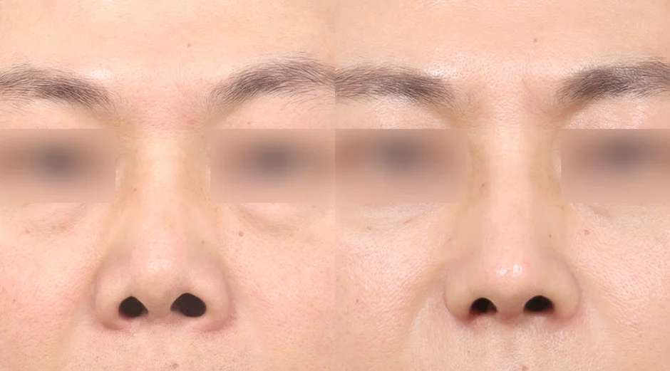 Rhinoplasty [Revisi+Hidung Pendek+Reduksi cuping+Rhinoplasty fungsional+Tulang rawan iga sendiri]