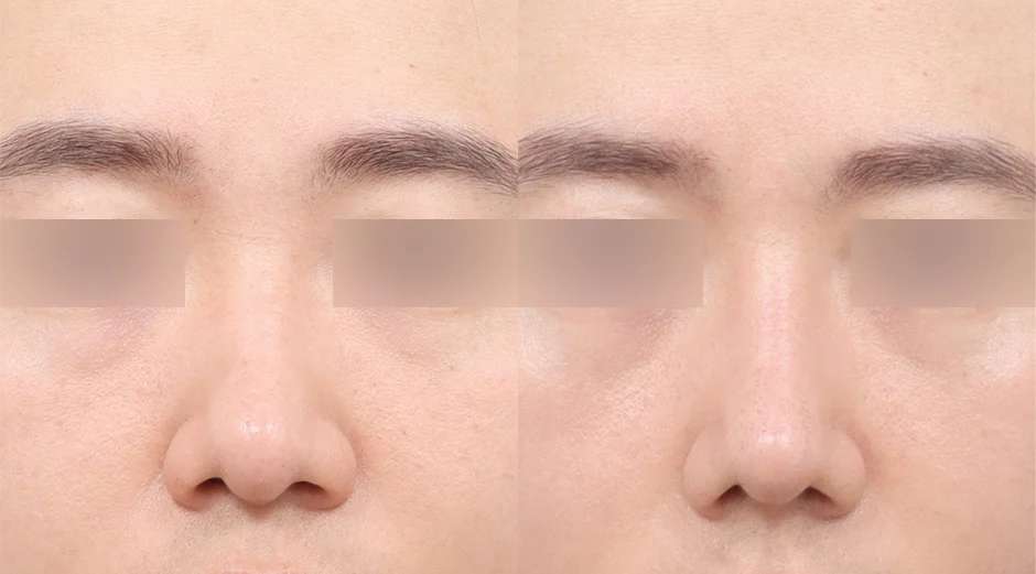 Rhinoplasty [Hidung punuk / Hidung bulat] / Reduksi cuping / Rhinoplasty fungsional / Tulang rawan iga sendiri