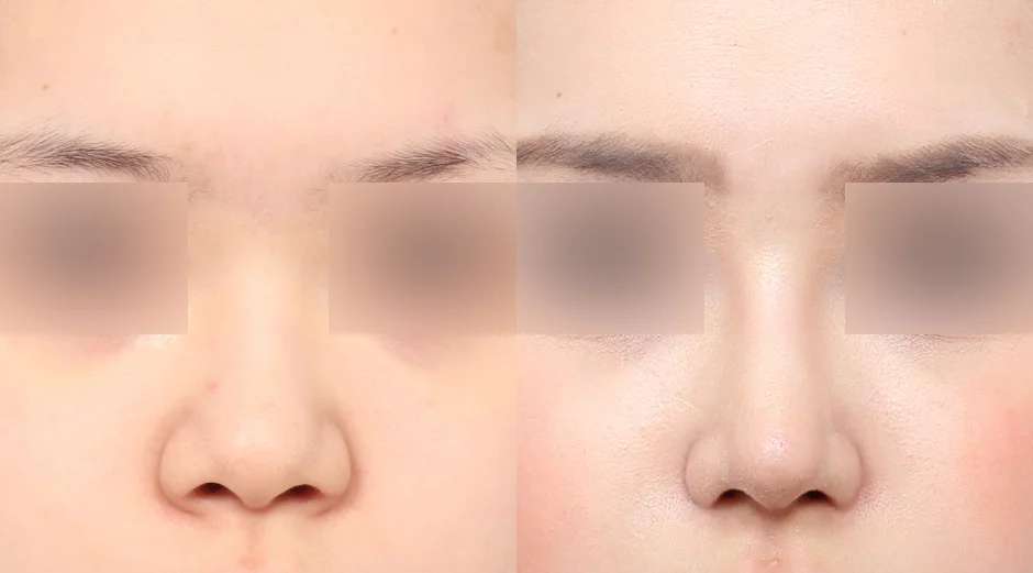 Rhinoplasty [Hidung pesek / Hidung bulat] / Reduksi cuping