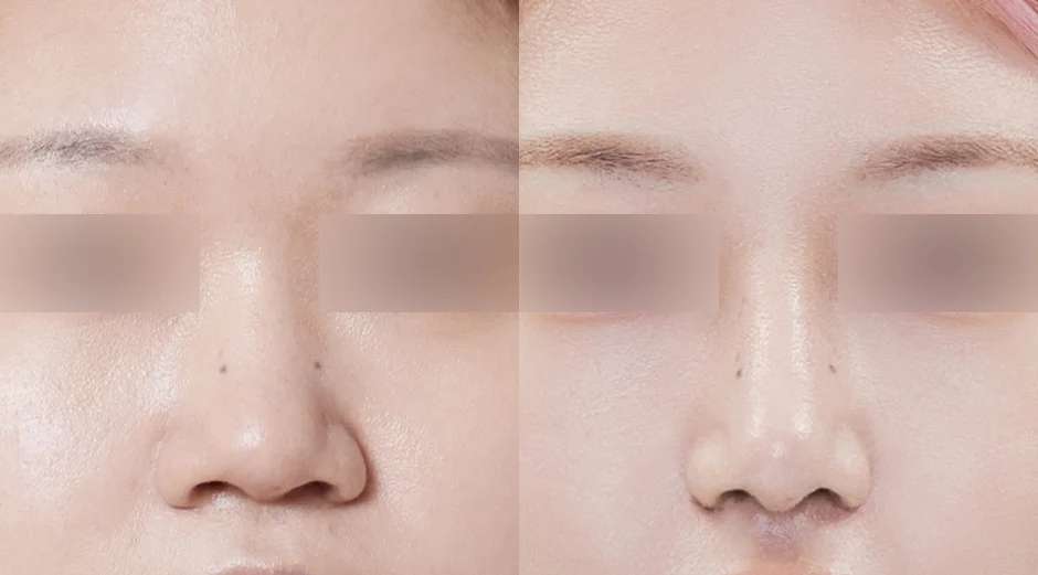Rhinoplasty [Hidung punuk / Hidung miring / Hidung bulat] / Reduksi cuping