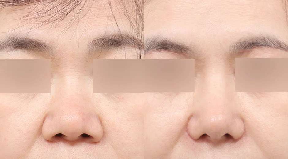 Rhinoplasty [Revisi / Hidung bulat / Osteotomi] / Reduksi cuping / Tulang rawan iga donor