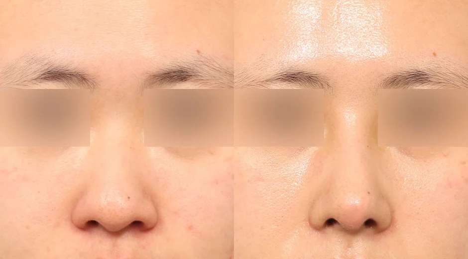 Rhinoplasty [Hidung bulat / Hidung miring] / Reduksi cuping