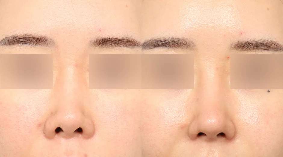 Rhinoplasty [Hidung pendek / Revisi] / Reduksi cuping