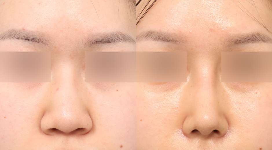 Rhinoplasty [Hidung punuk / Hidung bulat / Osteotomi] / Reduksi cuping