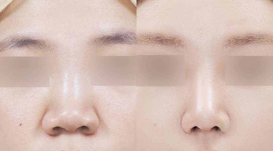Rhinoplasty [Hidung pesek / Hidung pendek / Hidung bulat] / Reduksi cuping / Koreksi sudut nasolabial / Rhinoplasty fung