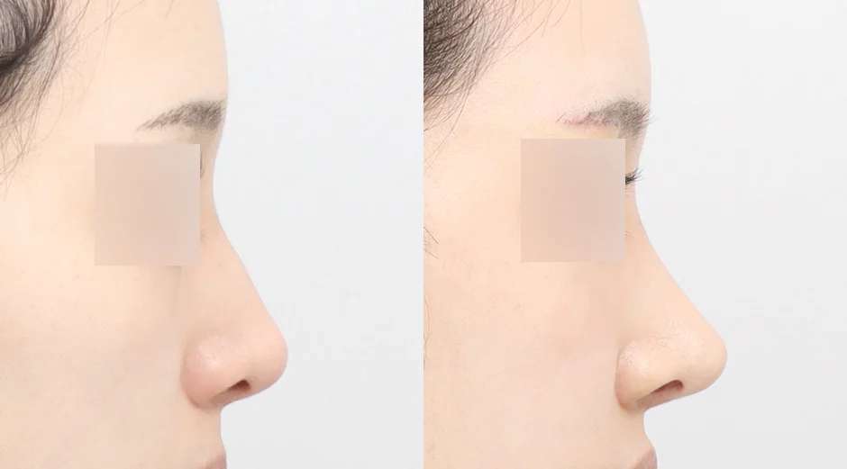 Rhinoplasty [Hidung pesek / Hidung punuk / Osteotomi]