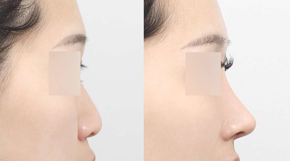 Rhinoplasty untuk pria [Tanpa implan / Hidung punuk / Osteotomi / Hidung panjang / Hidung bulat] / Tulang rawan telinga