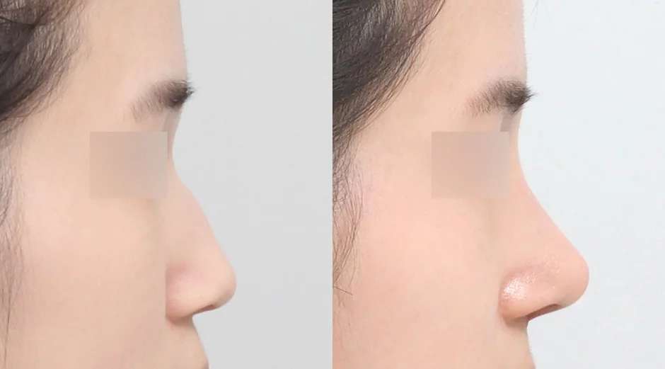 Rhinoplasty untuk pria [Hidung punuk / Hidung bulat / Hidung pendek]