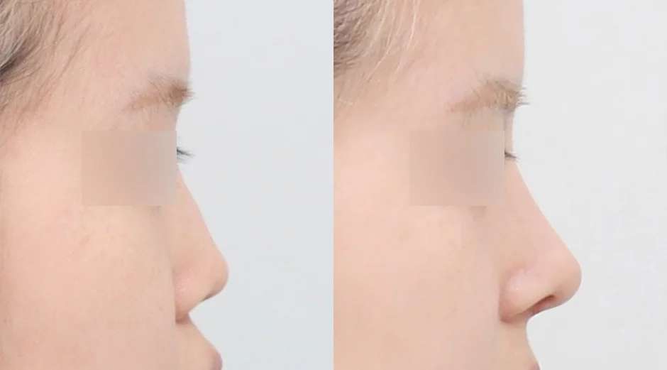 Rhinoplasty [Hidung punuk / Hidung bulat]