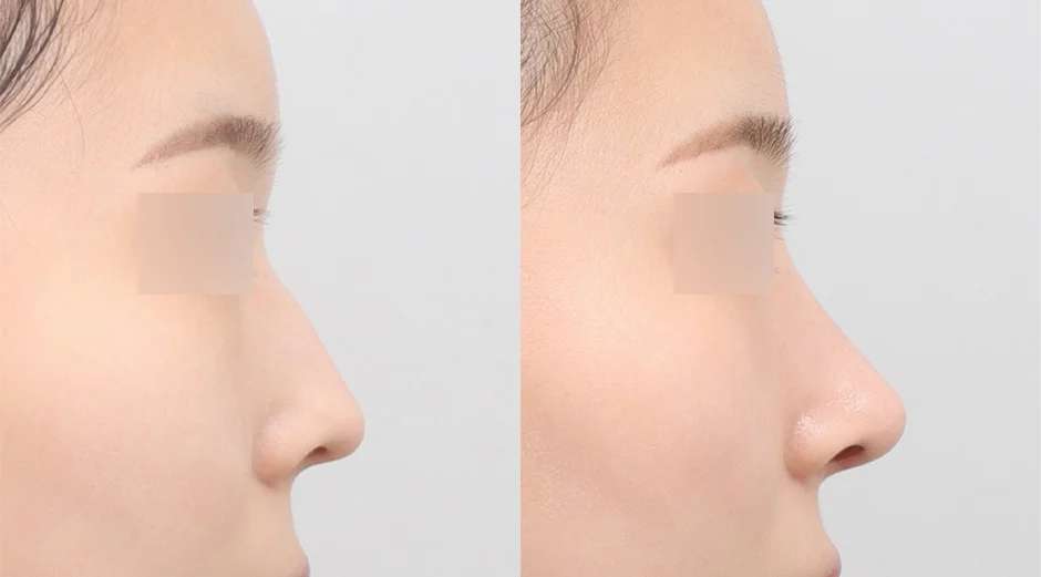 Rhinoplasty [Hidung punuk / Hidung bulat]