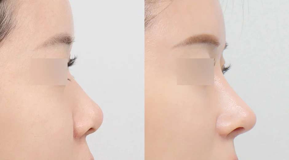 Rhinoplasty [Hidung punuk / Hidung bulat] / Reduksi cuping / Rhinoplasty fungsional / Tulang rawan iga sendiri