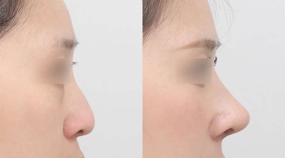 Rhinoplasty [Hidung bulat / Osteotomi / Hidung punuk] / Rhinoplasty fungsional / Tulang rawan iga donor