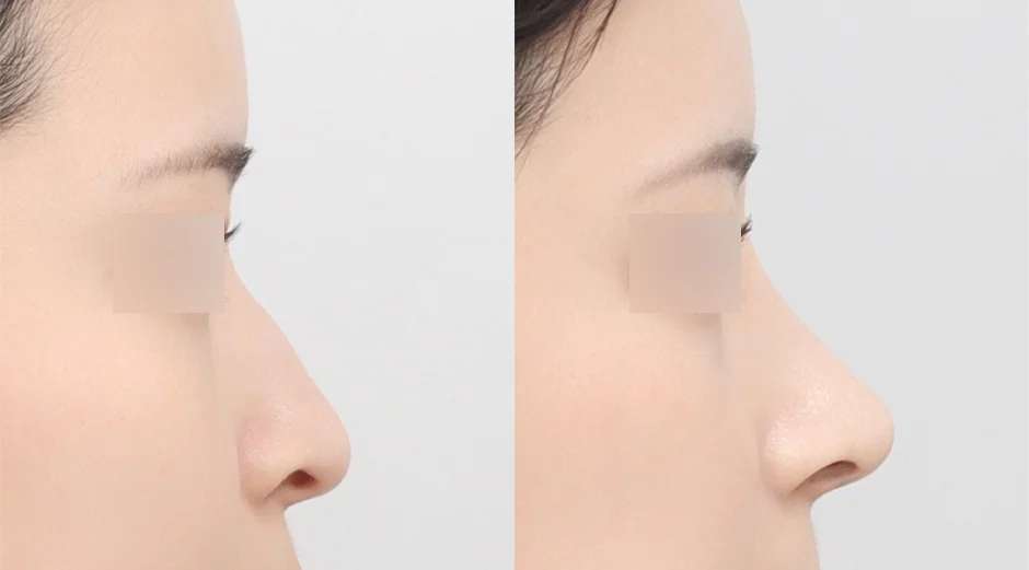 Rhinoplasty [Hidung punuk / Osteotomi / Hidung panjang] / Ujung hidung / Tulang rawan iga sendiri