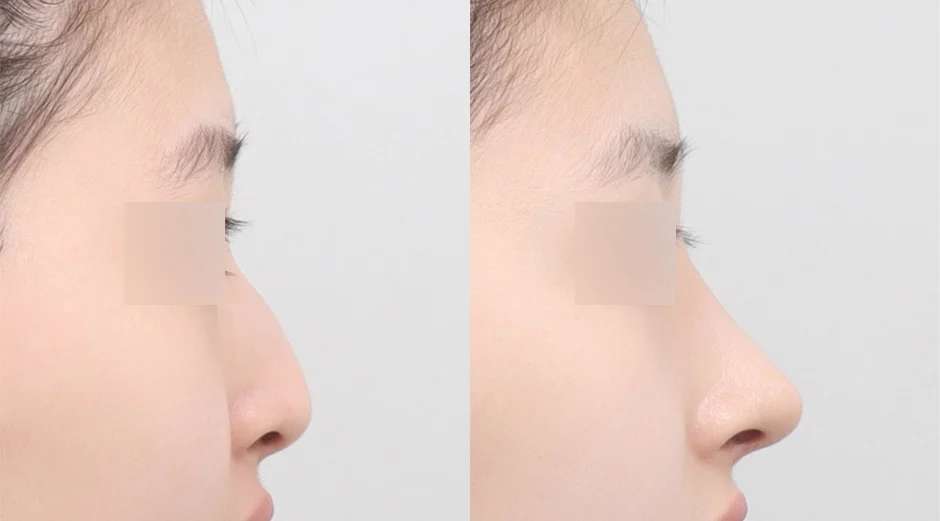 Rhinoplasty [Hidung punuk / Hidung bulat / Osteotomi] / Tulang rawan iga sendiri