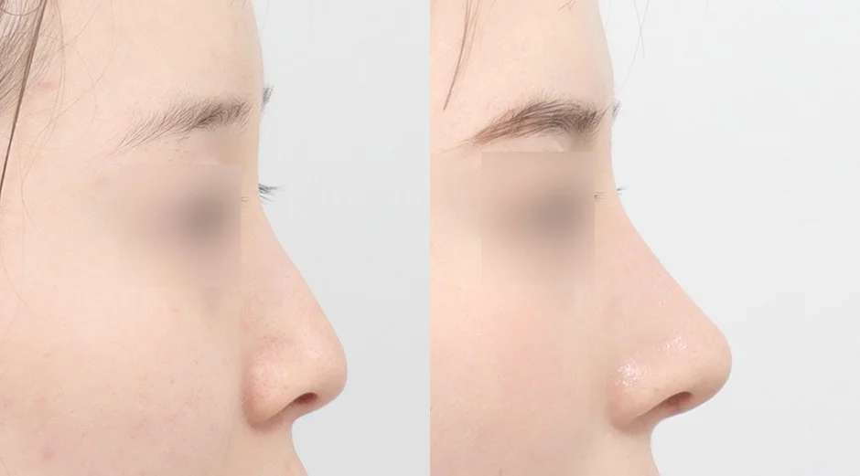 Rhinoplasty [Hidung punuk / Hidung bulat] / Reduksi cuping / Rhinoplasty fungsional / Tulang rawan iga sendiri