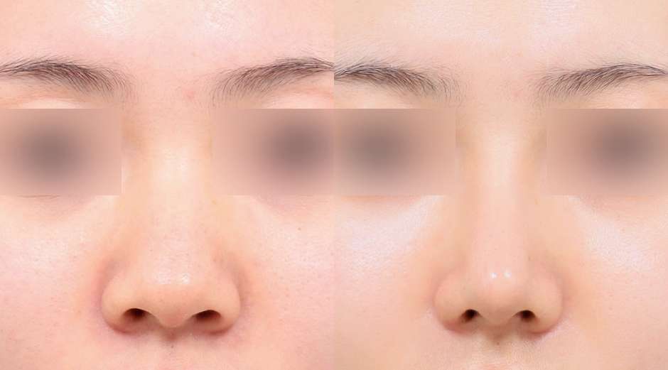 Rhinoplasty [Tanpa implan / Osteotomi / Hidung bulat / Hidung punuk] / Rhinoplasty fungsional