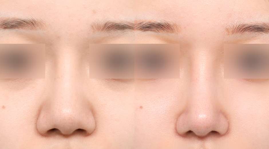 Rhinoplasty [Tanpa implan / Hidung punuk] / Rhinoplasty fungsional