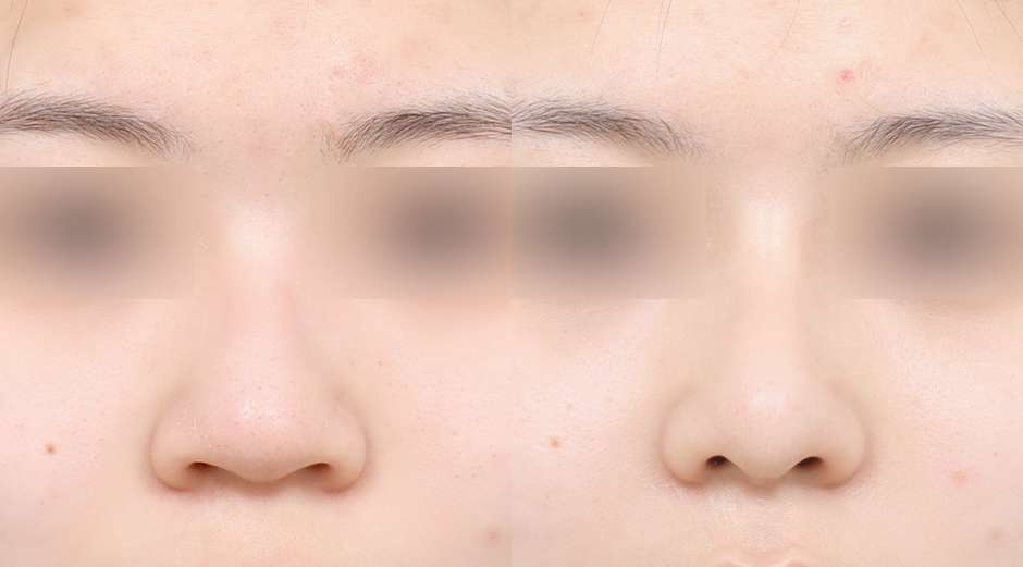Rhinoplasty [Tanpa implan / Hidung punuk] / Reduksi cuping