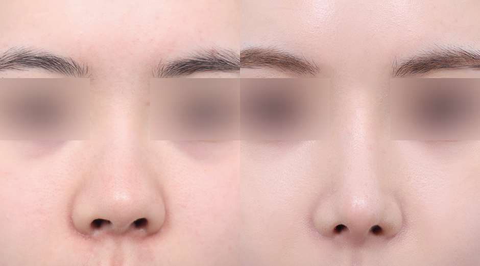 Rhinoplasty [Tanpa implan / Hidung pendek]