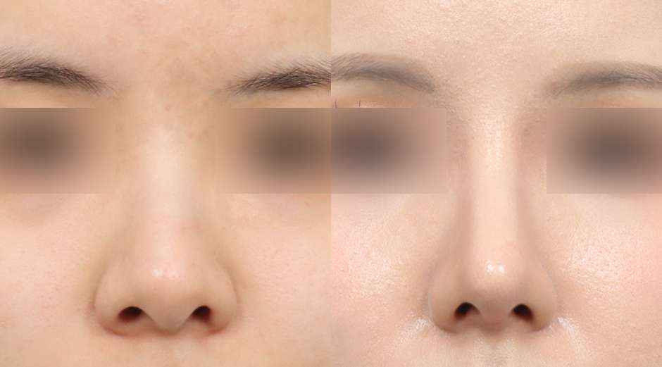 Rhinoplasty [Tanpa implan / Hidung punuk/ Hidung bulat] / Reduksi cuping