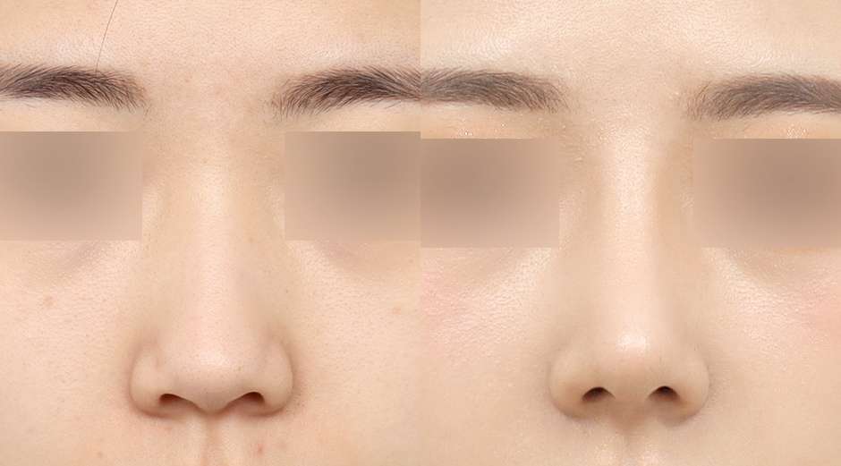 Rhinoplasty [Hidung punuk + Osteotomi + Hidung bulat + Tulang rawan iga]