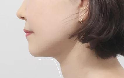 2 Bulan Setelah Operasi