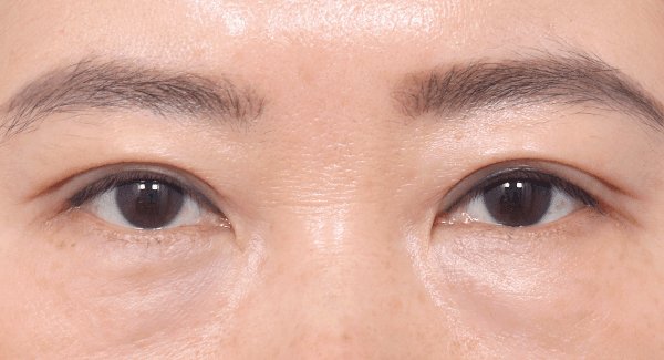 Garis alami yang menempel kuat,
tidak kendur bahkan setelah 1 bulan
