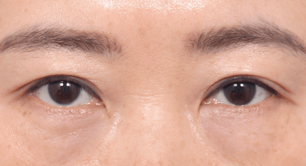 Dengan kontrol fiksasi otot mata yang tepat,
garis yang terbebas dari bekas luka bahkan setelah 6 bulan
