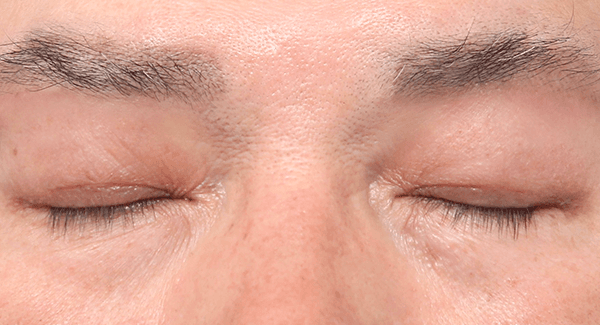 1 Bulan
Setelah Operasi
