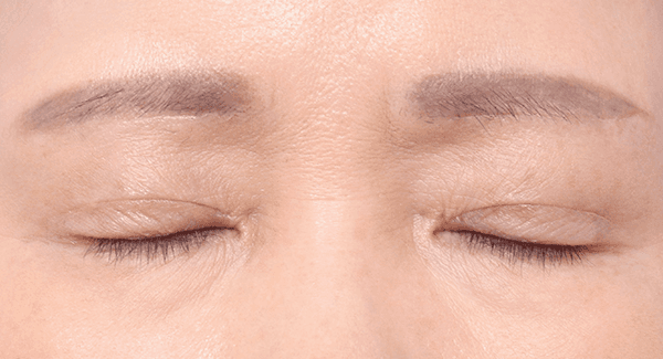 1 Bulan
Setelah Operasi
