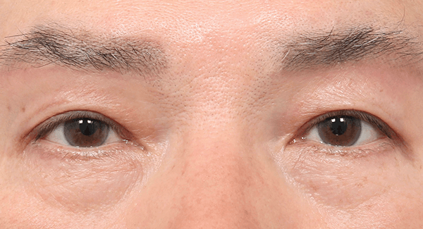 1 Bulan
Setelah Operasi
