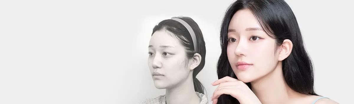 AB Foto Sebelum &
Sesudah Operasi