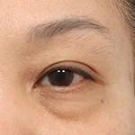 Lifting Upper Blepharoplasty