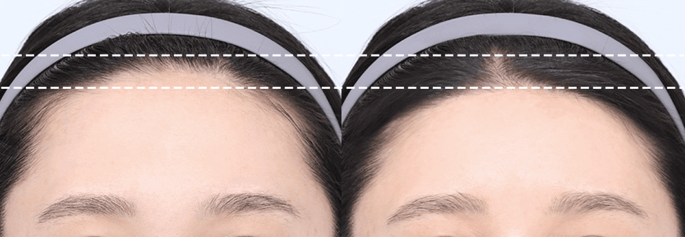 Efek yang jelas dari perubahan posisi kulit kepala