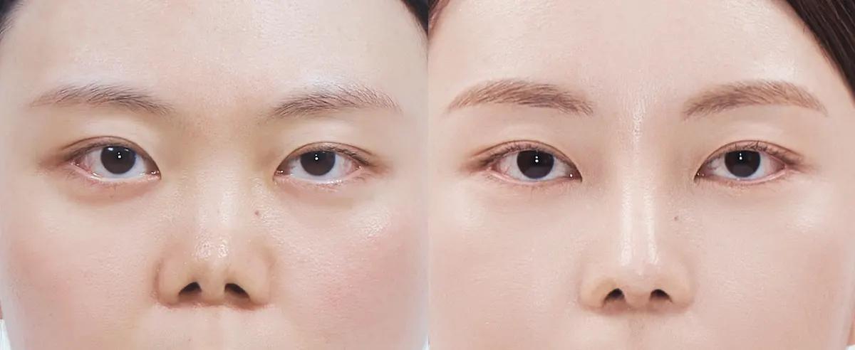 Before and after surgery