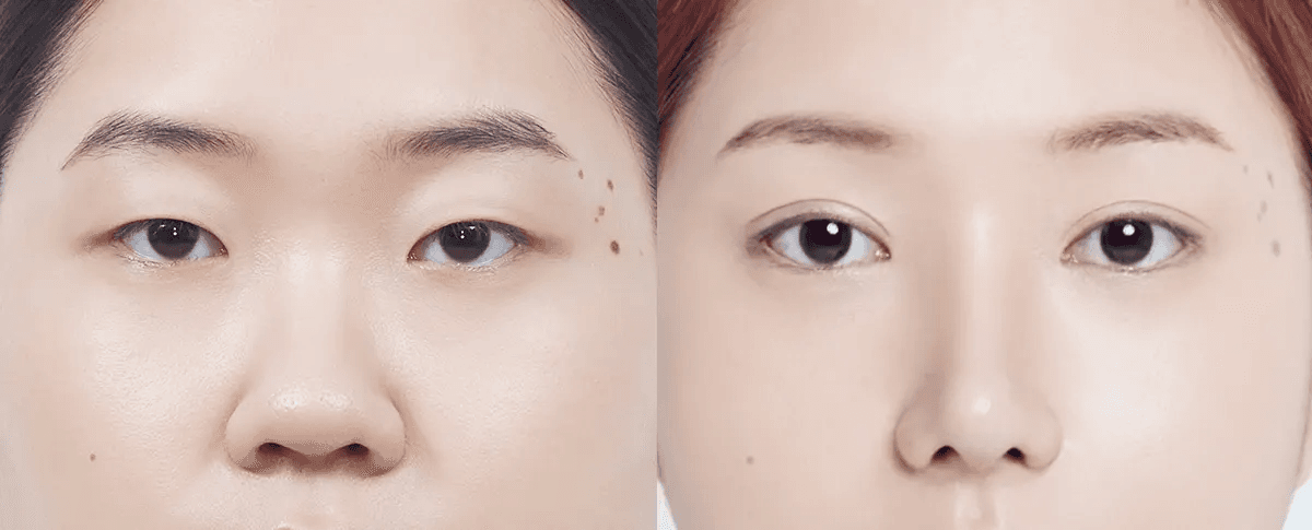 맥미걸 악플콜렉터 수술 전후 의학 사진