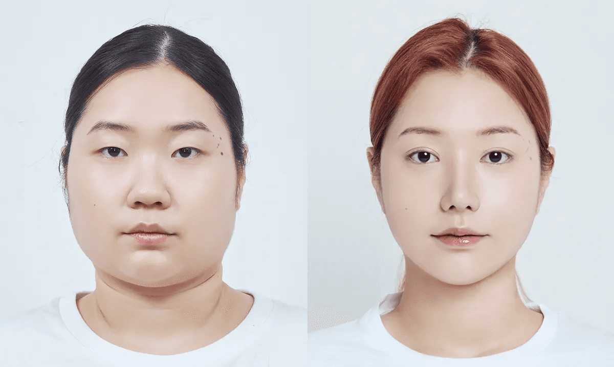 맥미걸 악플콜렉터 수술 전후 의학 사진