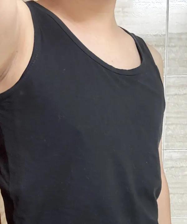 Before and after surgery front view