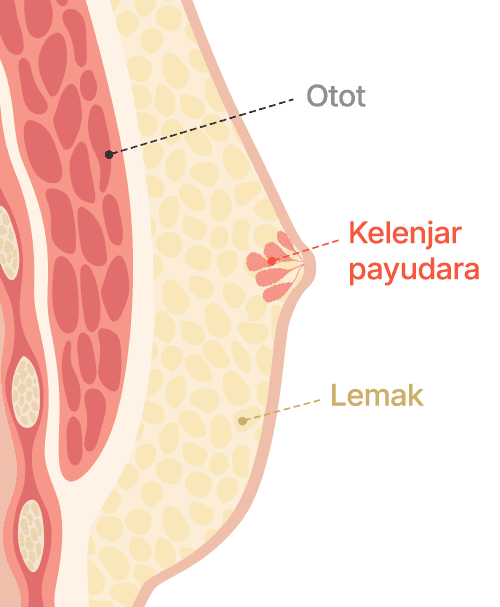 Gynecomastia surgery