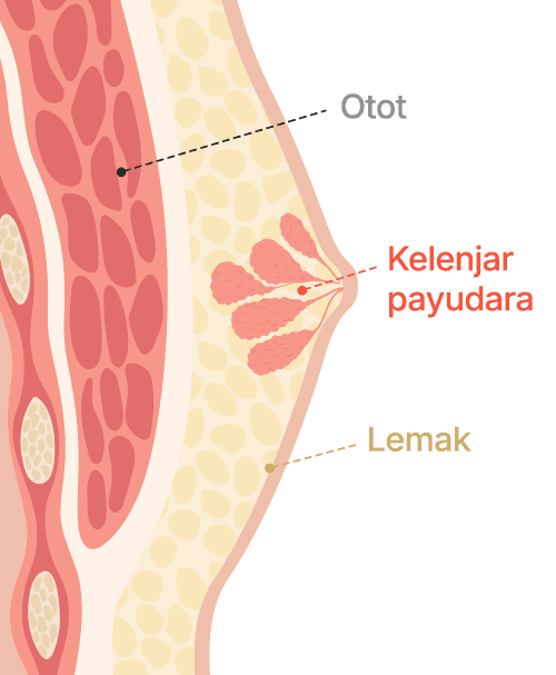 Gynecomastia surgery