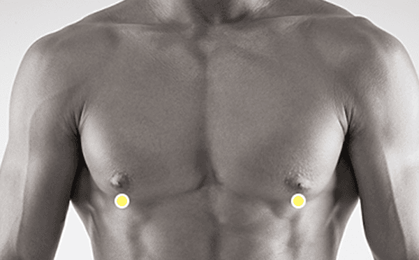 Gynecomastia surgery