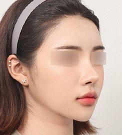 3 bulan setelah operasi