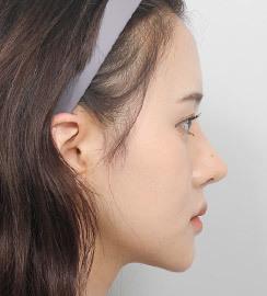 3 bulan setelah operasi