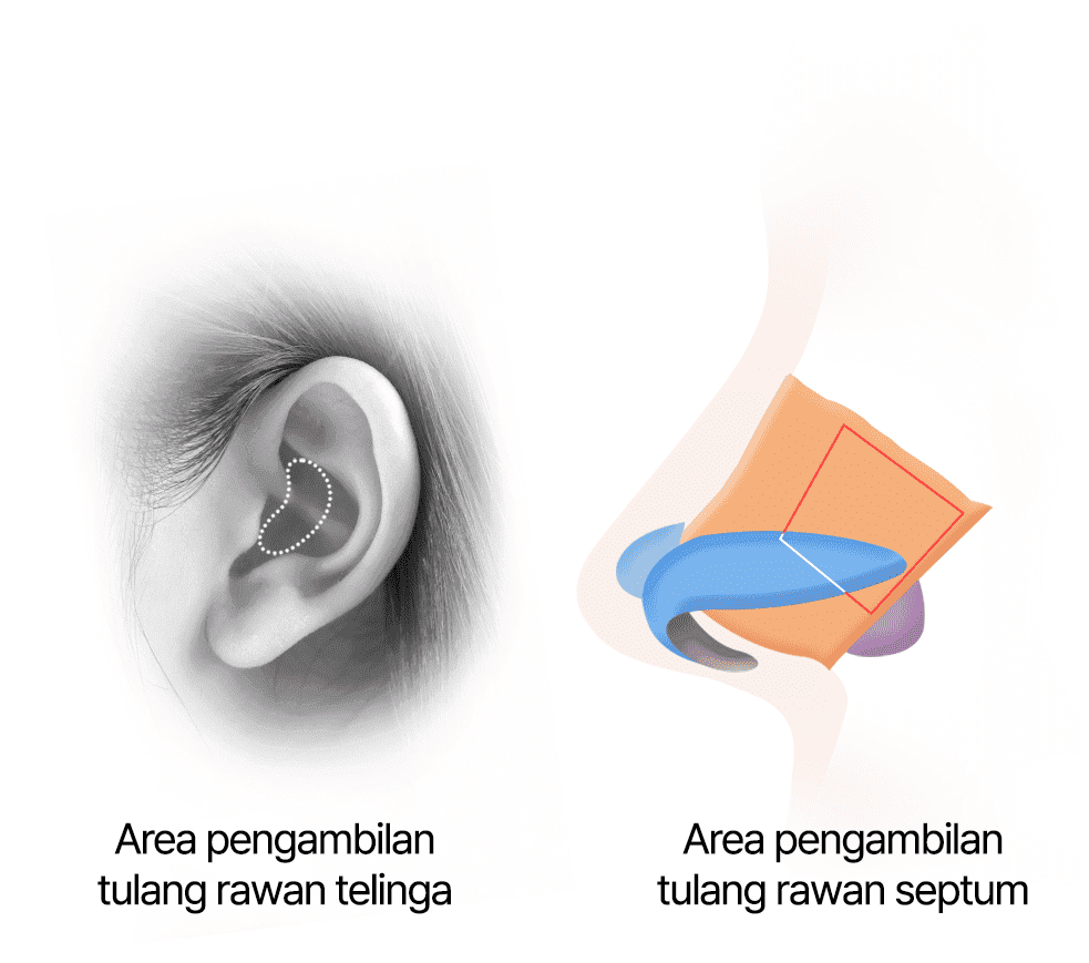 Pengambilan Tulang Rawan Telinga dan Tulang Rawan Septum