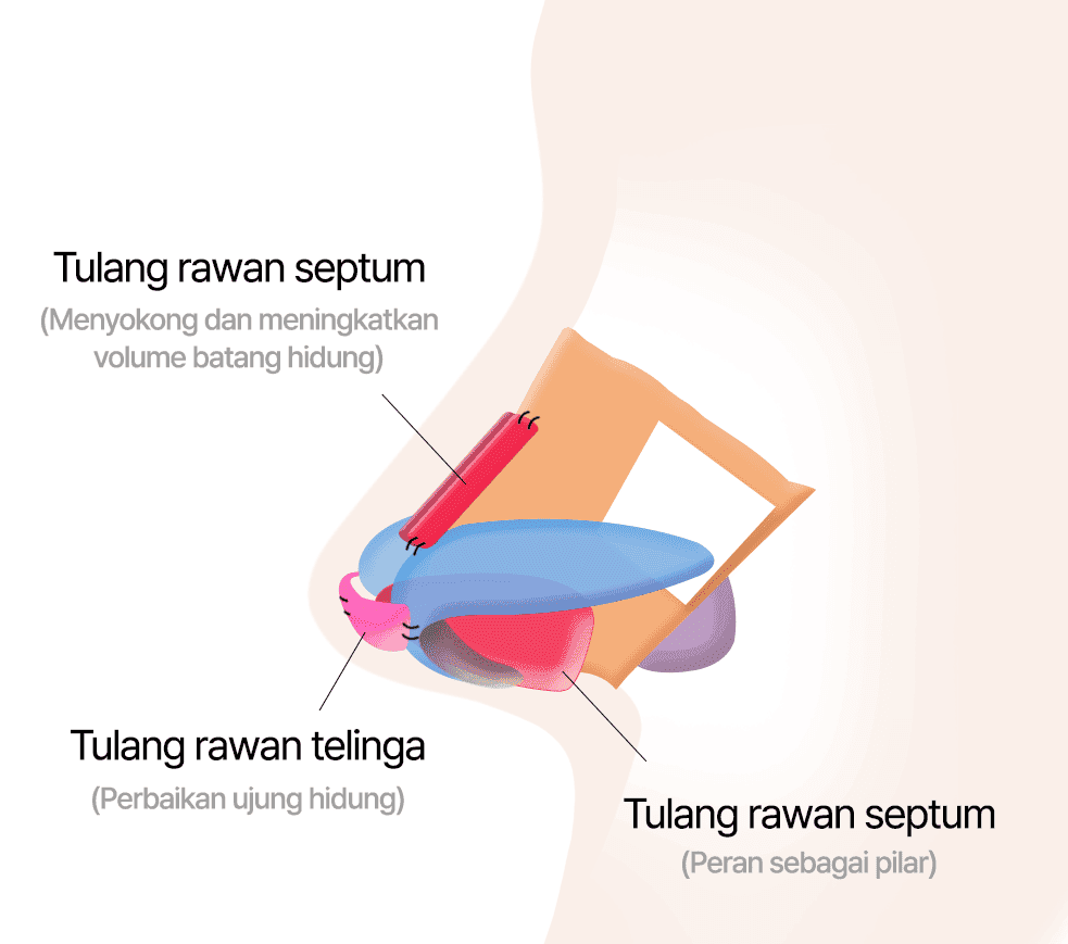 Koreksi Memakai Tulang Rawan Telinga dan Tulang Rawan Septum