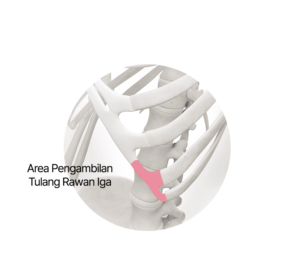 Pengambilan Tulang Rawan Iga