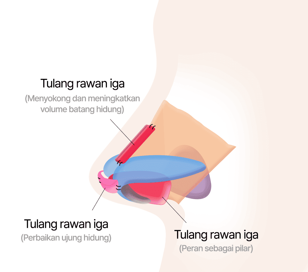 Koreksi Memakai Tulang Rawan Iga