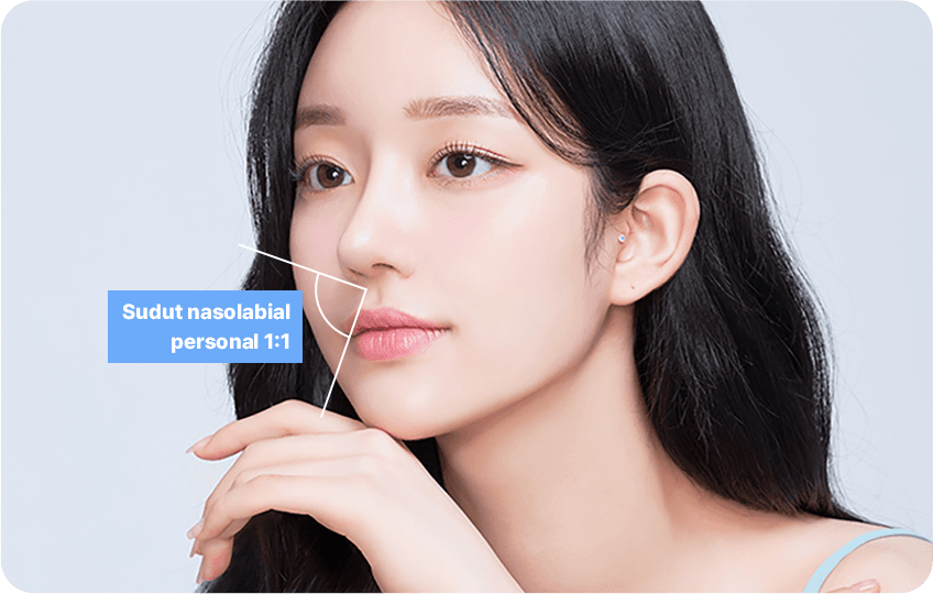 1:1 customized nasolabial angle