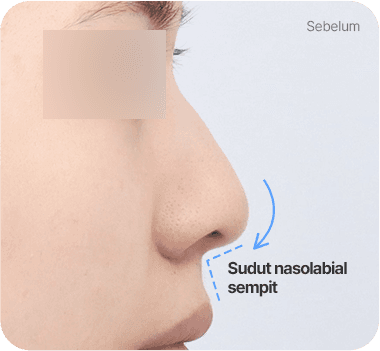 CASE 1. Sudut Nasolabial Sempit before